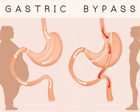 5 Tips To Prepare For Gastric Bypass Surgery Bass Bariatric Surgery