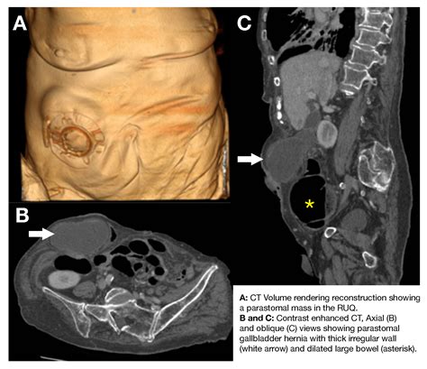 The Unusual Suspects Parastomal Hernia Of The Gallbladder With
