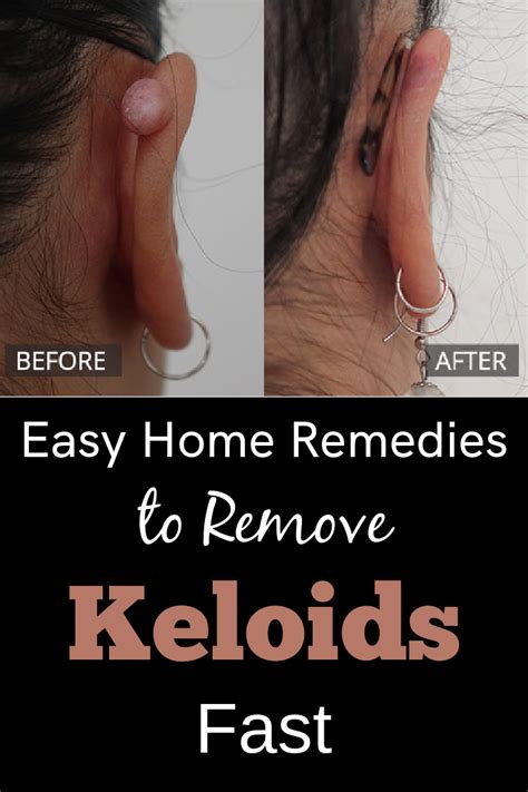 How To Get Rid Of Keloids Fast Try These Home Remedies