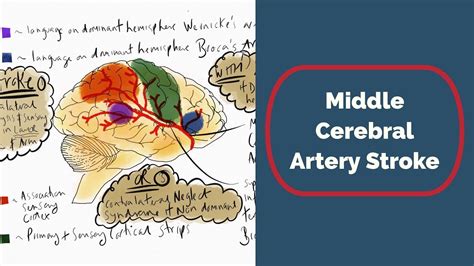 The mca is by far the largest cerebral artery and is the vessel most commonly affected by cerebrovascular accident. Middle Cerebral Artery Stroke - YouTube