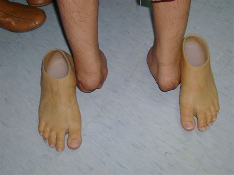 Synergy Functional Prosthetic Silicone Partial Foot Prosthesis Below