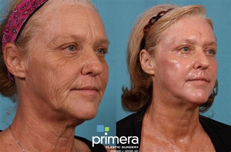 Before And After Photos Of Deep Chemical Peel