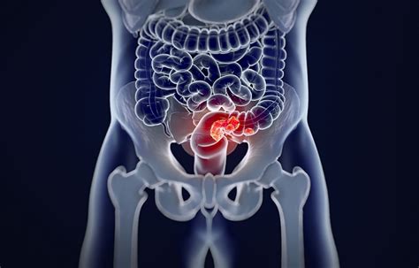 Colorectal Cancer Pictures