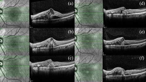 Spectral Domain Optical Coherence Tomography Sd Oct Changes During