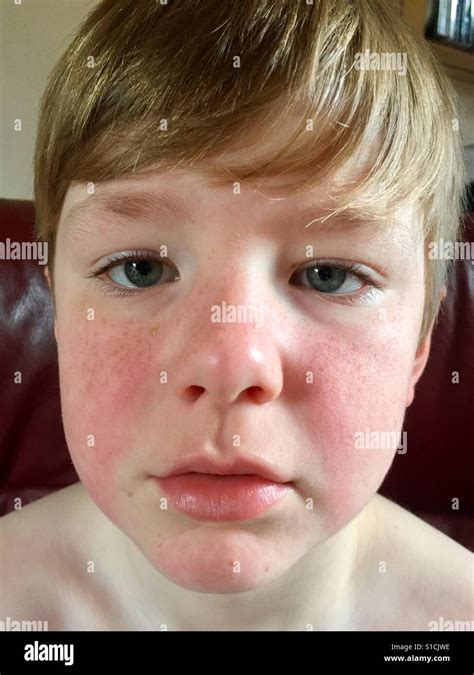 Boy With Chronic Idiopathic Urticaria Hives Stock Photo Alamy
