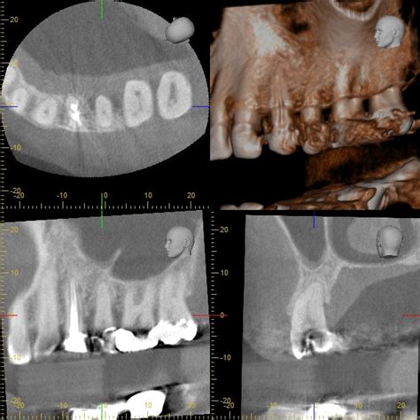 Part Of Full Mouth Cone Beam Computed Tomography Cbct With