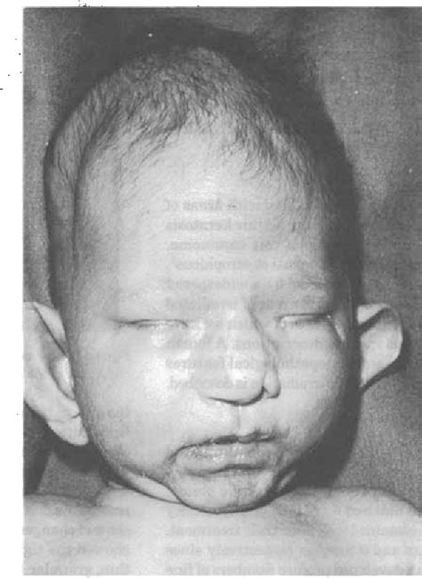 Figure 1 From Focal Dermal Hypoplasia Syndrome In The Neonate Semantic Scholar