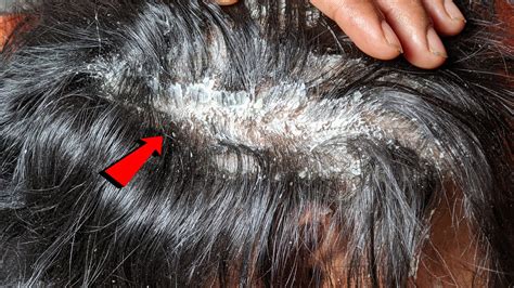 Dandruff Shampoo And Scratching Itchy Dry Scalp Huge Flake