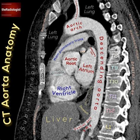 Check Out This Sagittal View Of A Ct Aorta Take Note Of We