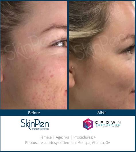Skin Pen Before And After Skin Pen Microneedling