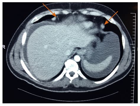 Unusual Radiologic Presentations Of Malignant Peritoneal Mesothelioma