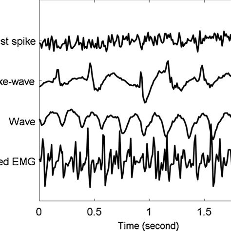 pdf eeg analysis of seizure patterns using visibility graphs for detection of generalized seizures
