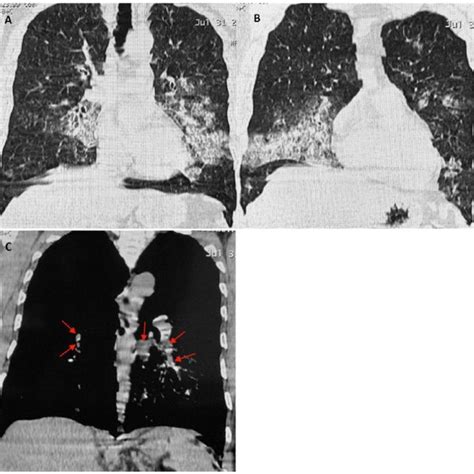 Chest Xray A Showing Patchy Infiltrates In Bilateral Lower Zones