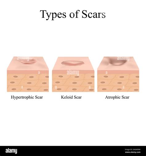 Types Of Scars Acne Scars Keloid Hypertrophic Atrophic