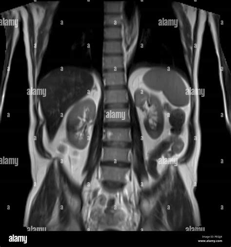 Abdomen Mri Scan Hi Res Stock Photography And Images Alamy