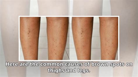 Brown Spots On Legs Causes And Removal Guide Youtube