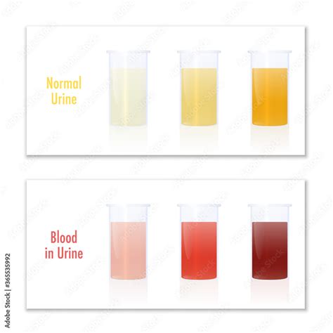 Blood In Urine Color Infographic Chart Blood In Urine And Normal Urine In Specimen Cups As
