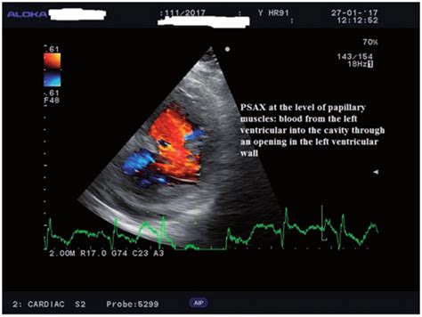 Parasternal Short Axis Psax View At The Level Of The Papillary