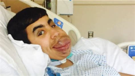 teen reveals new look after face tumor removed wgn tv
