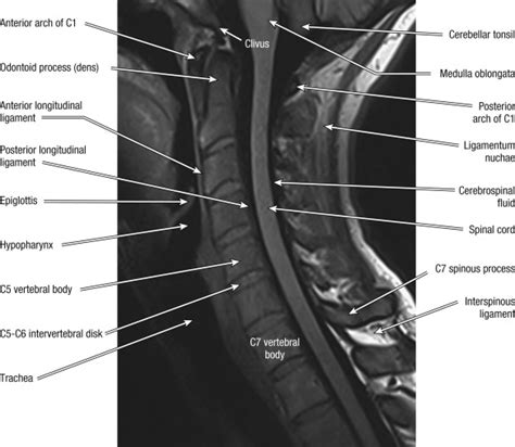 Magnetic Resonance Imaging Of The Cervical Spine Musculoskeletal Key