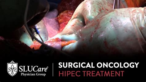 Cytoreductive surgery with hipec is a powerful, new treatment for peritoneal surface malignancy. Using Surgery and Chemotherapy to Treat Abdominal Cancers ...