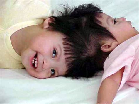 Craniopagus Twins Bing Images Conjoined Twins How To Have Twins Twins