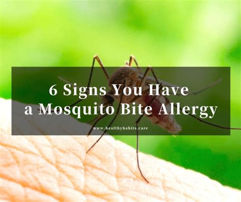 6 Signs You Have A Mosquito Bite Allergy Healthy Habits