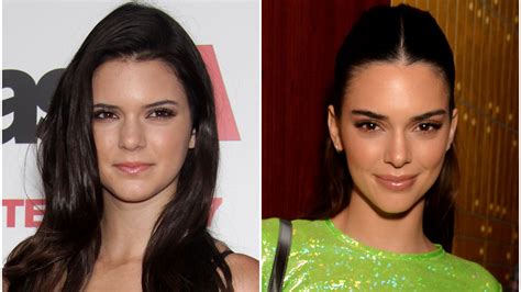 Has Kendall Jenner Had Plastic Surgery Evertyhing Shes Said