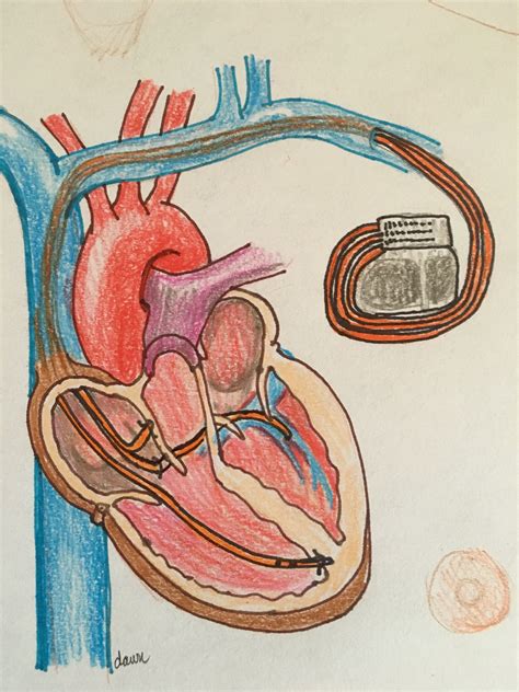 Cardiac Resynchronization Therapy Circulation Hot Sex Picture
