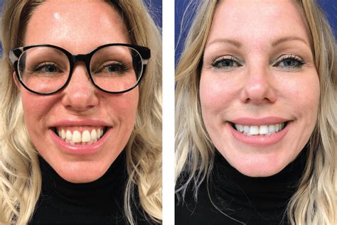 Traitements Gummy Smile Botox Médecine Esthétique Clinicare