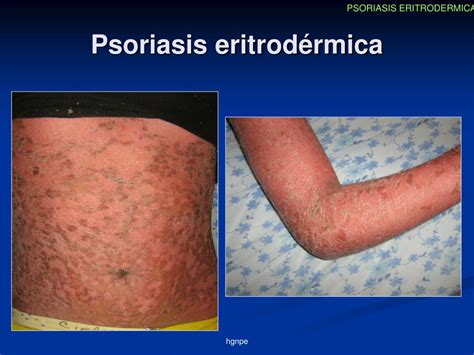Ppt Psoriasis Eritrod É Rmica Powerpoint Presentation Free Download