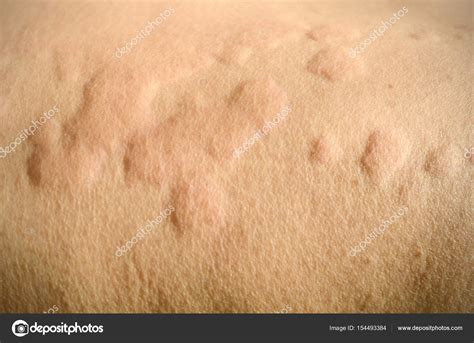 Skin Rash Urticaria Allergic Skin Stock Photo By ©areeya 154493232