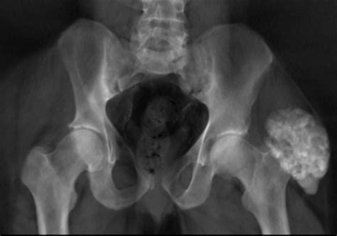Tumoral Calcinosis Of The Sternum And Hip A Rare Cause Of An Antalgic