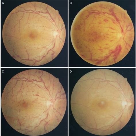 Pdf Clinical Progress In Impending Central Retinal Vein Occlusion