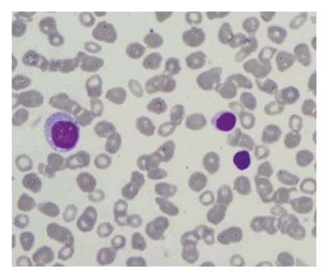 Peripheral Blood Smears Wright Giemsa Stained Showing Dimorphic
