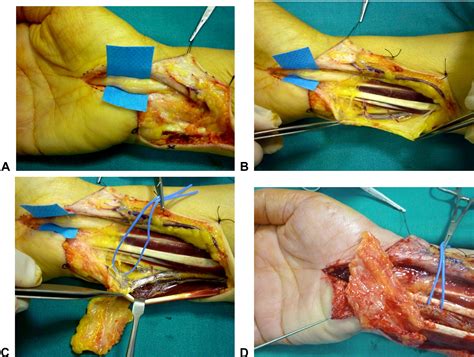 Treatment Of Painful Median Nerve Neuromas With Radial And Ulnar Artery