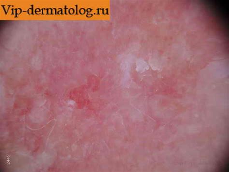 Фото злокачественного заболевания базалиома и актинического кератоза