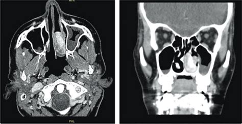Axial And Coronal Sinus Contrast Enhanced Ct Scans Showing A