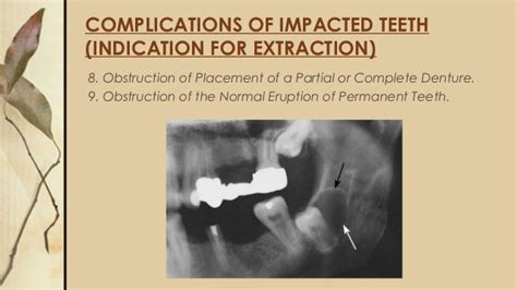 Surgical Removal Of Impacted Teeth