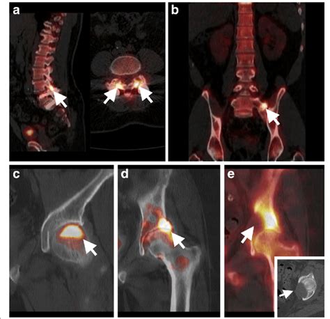 Bone Spectct Imaging Of Referred Pain Illustration Of Bone Spectct