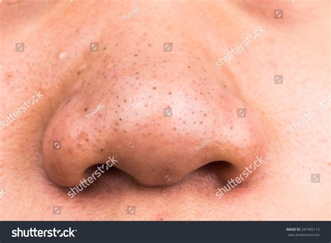 Pimple Blackheads On Nose Asian Teenager Stock Photo 241995115