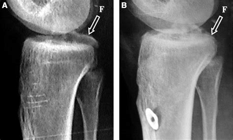 Arthroscopic Treatment Of Acute Tibial Avulsion Fracture Of The
