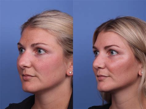 Rhinoplasty Before And After Pictures Case 327 Scottsdale Az