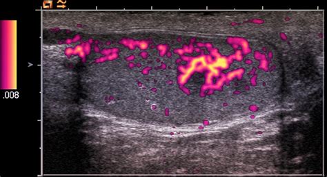 Testicular Cancer Ultrasound Scan Photograph By Du Cane Medical