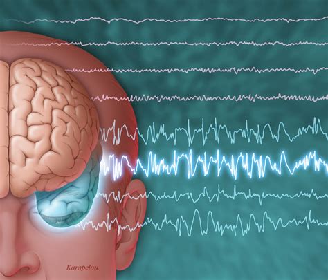 Eslicarbazepine Reduces Seizures Improves Hrqol In Epilepsy