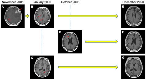 Findings On Enhanced Brain Mri Scans A Brain Mri Performed In