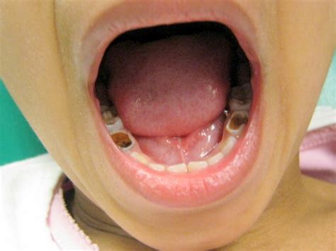 Help Us Stop Early Childhood Cavities Indiegogo