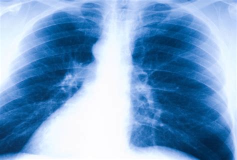 The first step of a mesothelioma diagnosis. Mesothelioma Cancer >>> Health-Zine.Info