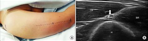 Ultrasonographic Evaluation Of Radial Nerve At The Spiral Groove A