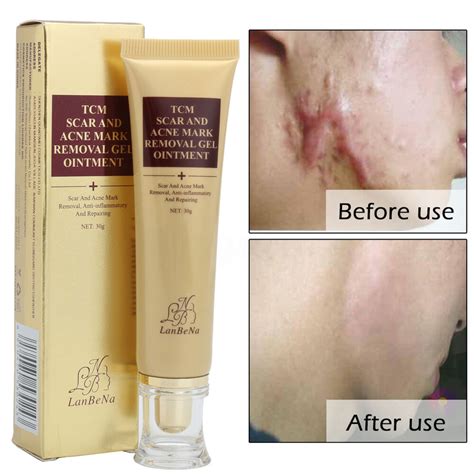 Scar removal cream natural scar pm, formula. LanBeNa Acne Scar Removal Cream Skin Repair Face Cream ...